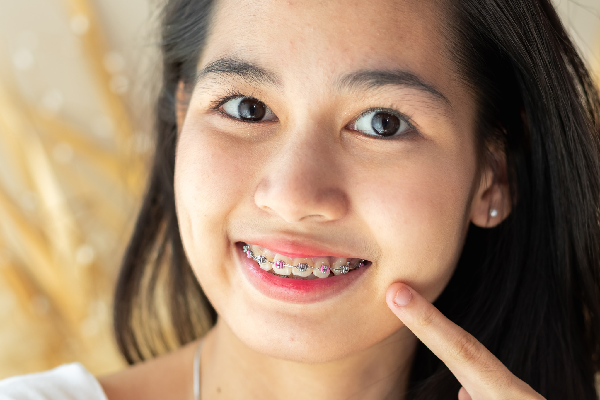 Young female beautiful smile with braces. Close up beautifying t